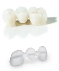 Ganzheitliche Zahnmedizin Metallfreier Zahnersatz